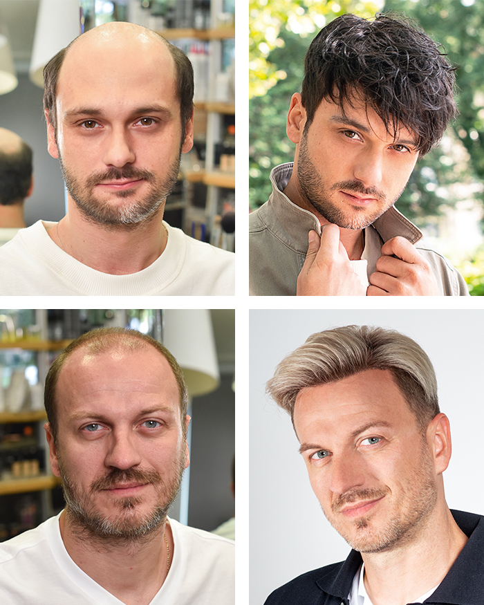 ContactSkin®SPEED: Schnelles Haarsystem für Männer - Vorher, Nachher