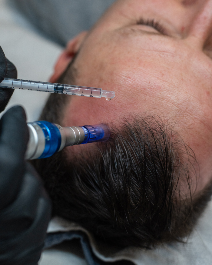 Neues Studio für Haargesundheit und Haarwachstum eröffnet in Biberach an der Riß. Nahaufnahme eines Mannes und dessen Haarausfall