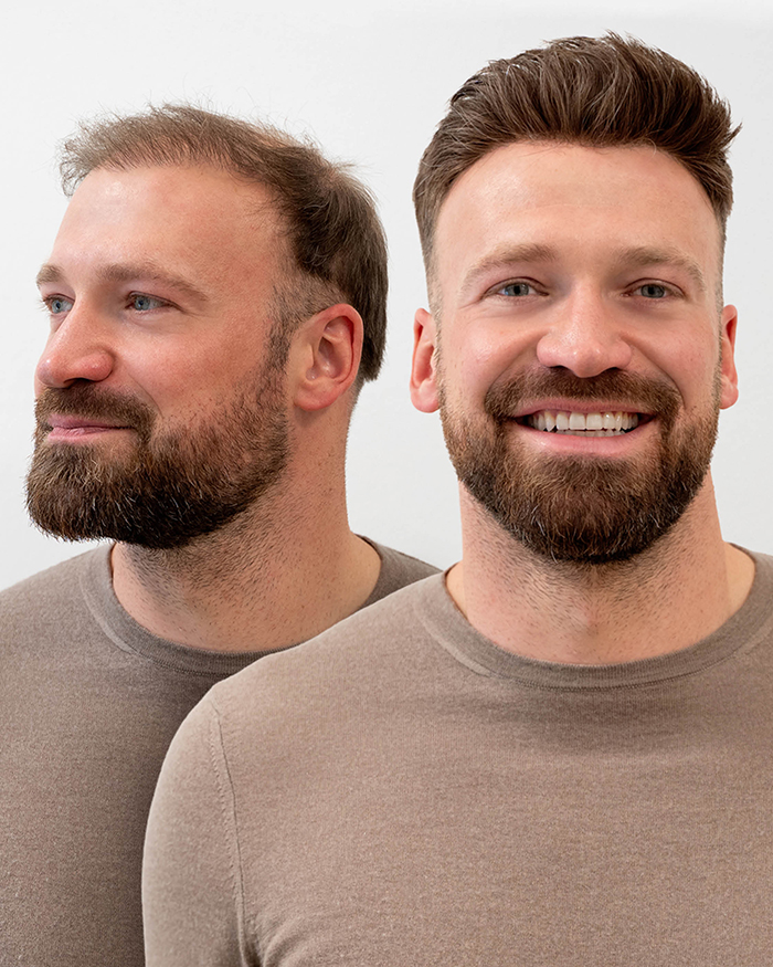 Haartransplantation: Kosten, Risiken, Boom